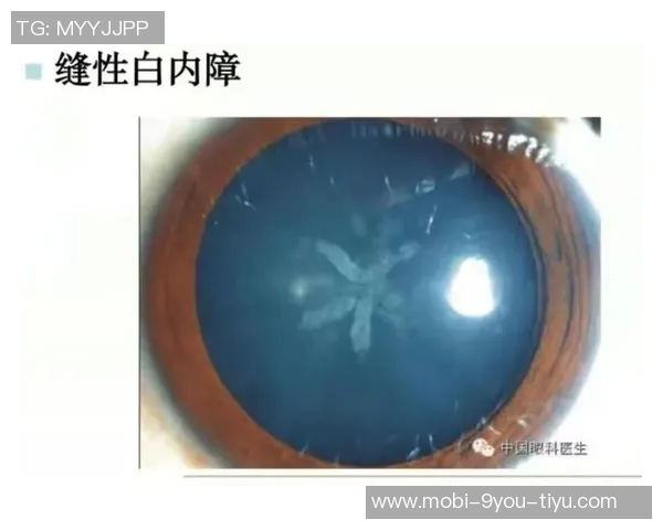 西媒揭示赫伊森眼睛难以睁开的原因是先天性眼睑下垂但不影响视力